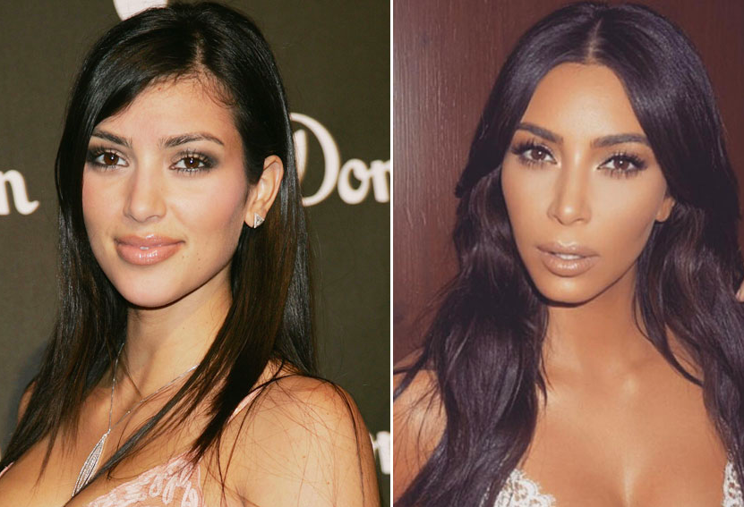 celebrities Admitted having Plastic Surgery 