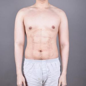 instant-8-pack-now-possible-at-cosmetic-clinic-in-bangkok-6
