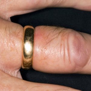 1800ss_science_source_rm_swollen_ring_finger