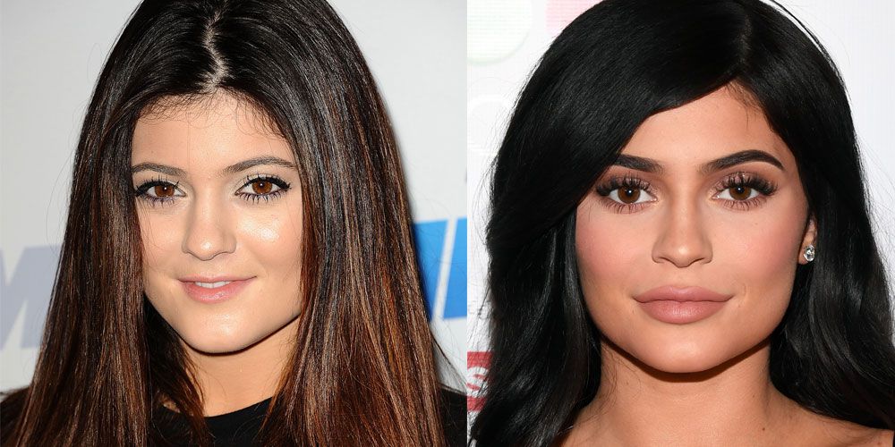 celebrities got plastic surgeries